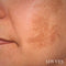 Depigmentierendes Gesichtsflecken-Aufhellungsserum