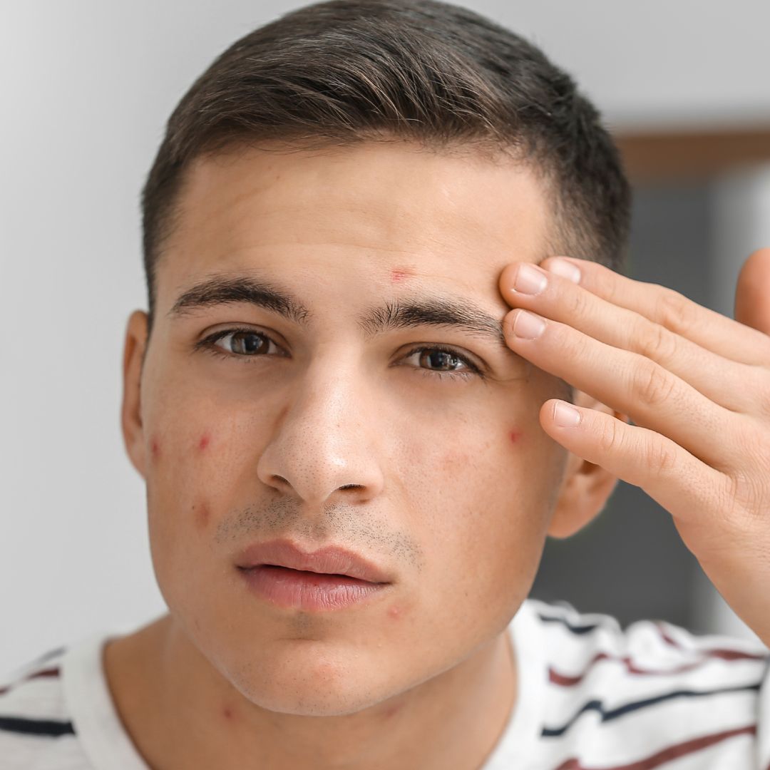 Pickelbehandlungsserum 